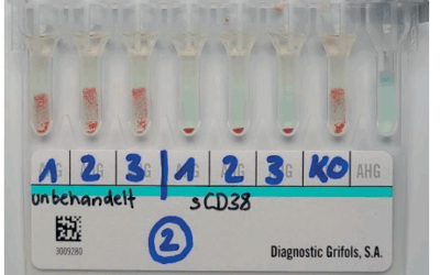 sCD38 Grifols: uma solução prática para a panreatividade por anti-CD38 em pacientes com mieloma múltiplo em uso de anti-CD38