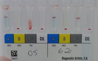 D-fraco na prática laboratorial: como lidar com esse resultado na bancada transfusional e no pré-natal