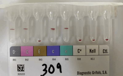 Sistema Kell: por que ele é um dos mais importantes da Imuno-hematologia?